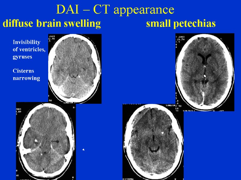 DAI – CT appearance diffuse brain swelling       